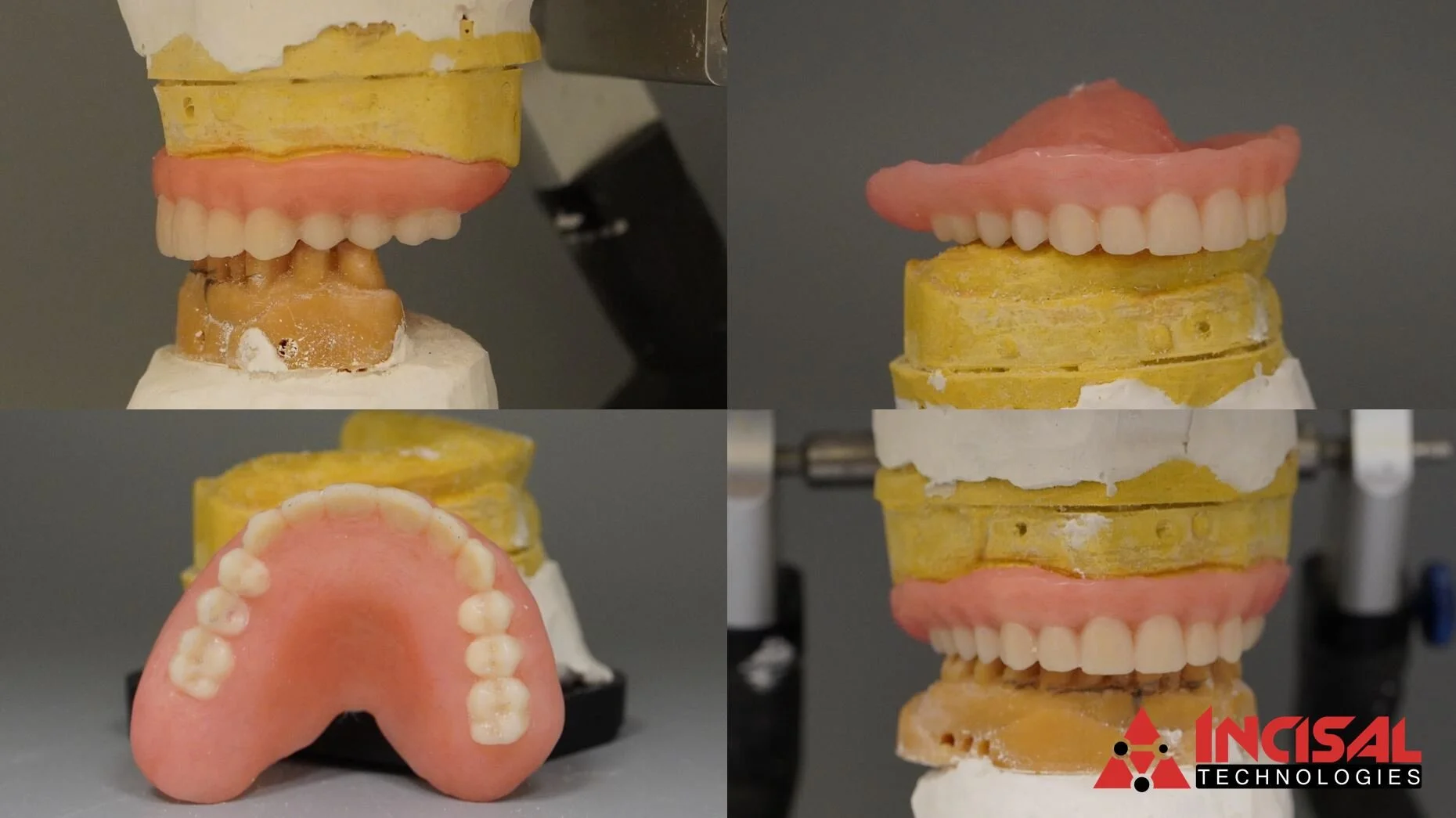 Surgical Upper Denture