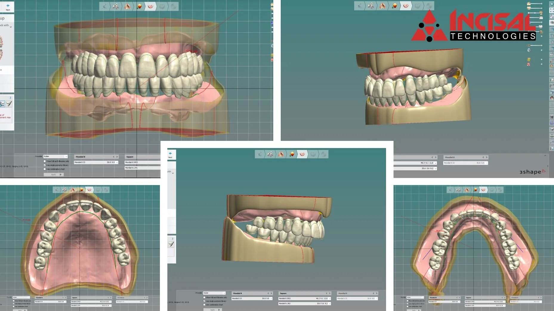U/L Digital Dentures