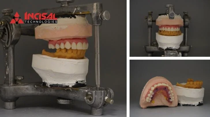 Hybrid Denture Wax-Up