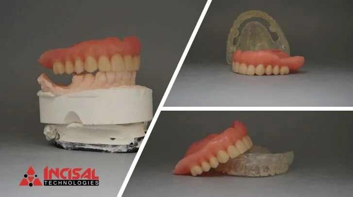 Upper Denture