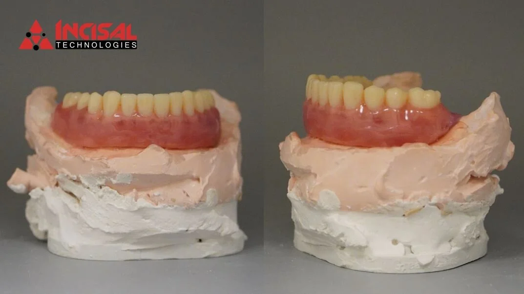 Lower Denture Wax-Up