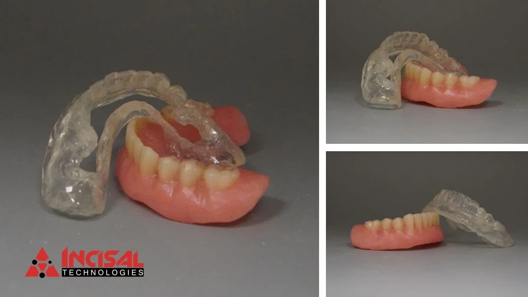 Lower Denture and Surgical Guide