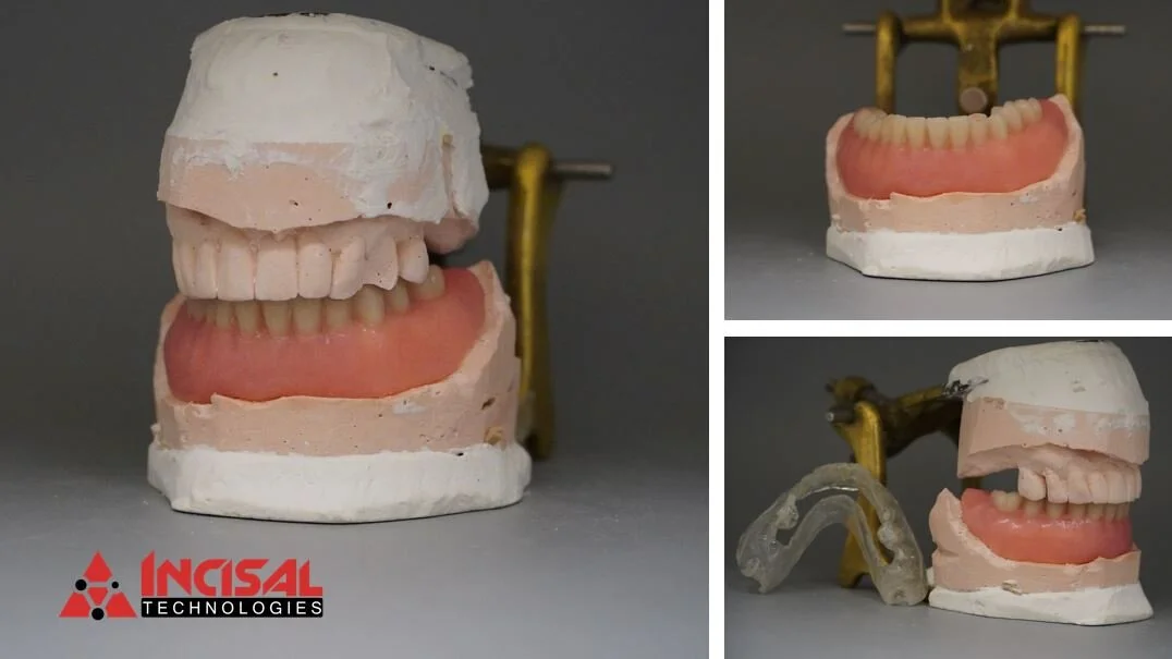 Lower Denture and Surgical Guide 2