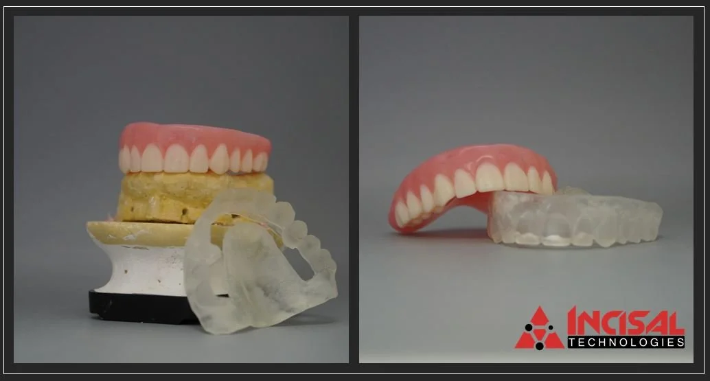Immediate Dentures and Surgical Guides