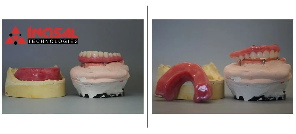 Wax Rim and Wax Try In