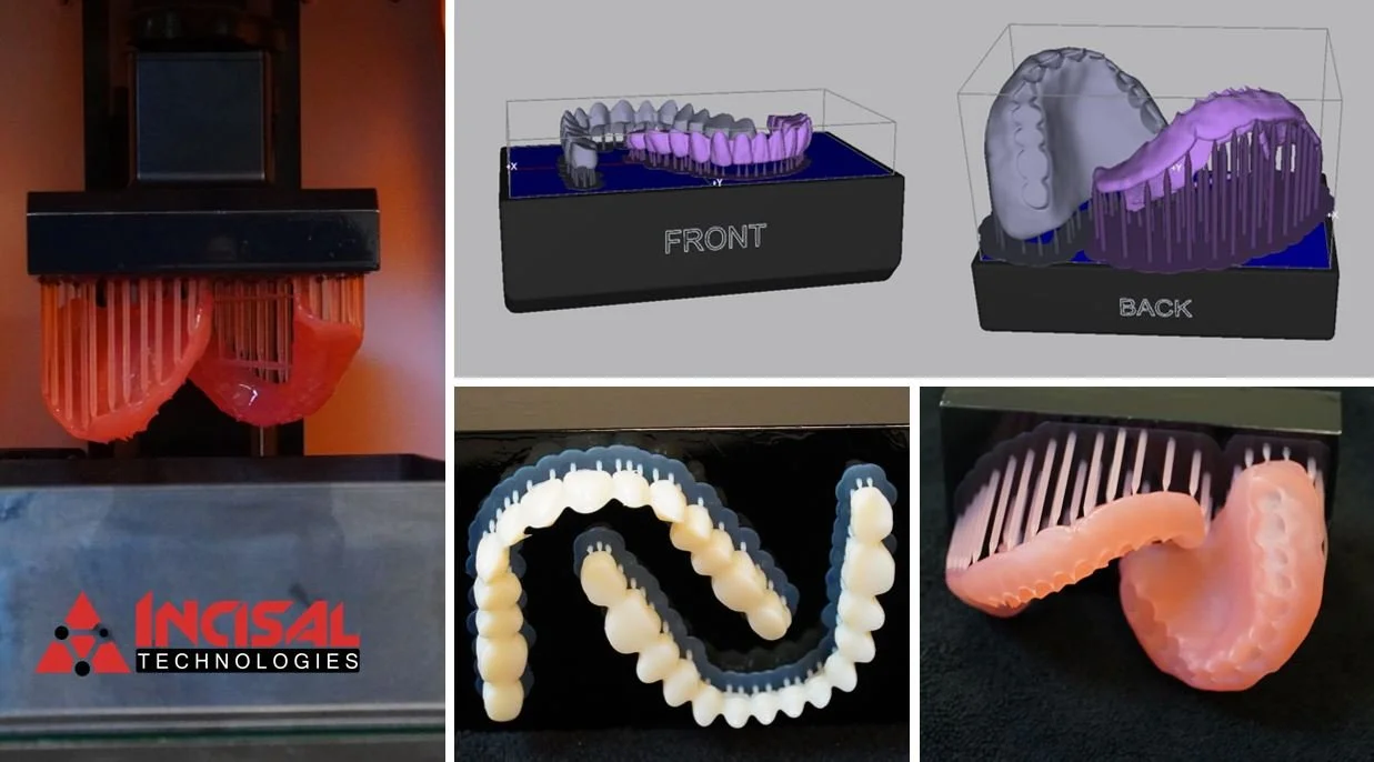 3D Printed Dentures