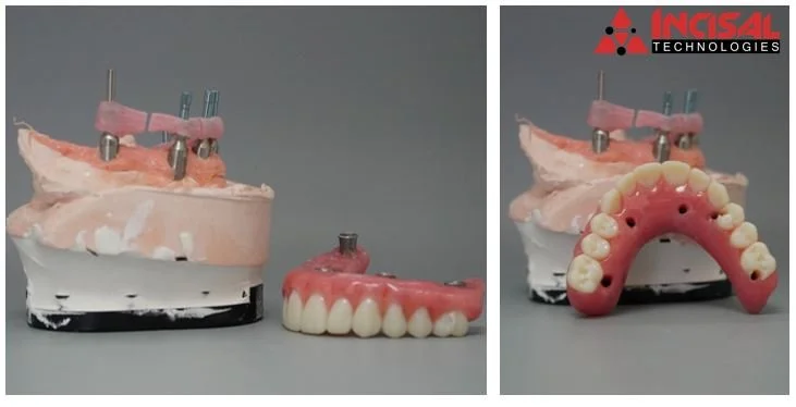 Full Arch Hybrid Prosthetics