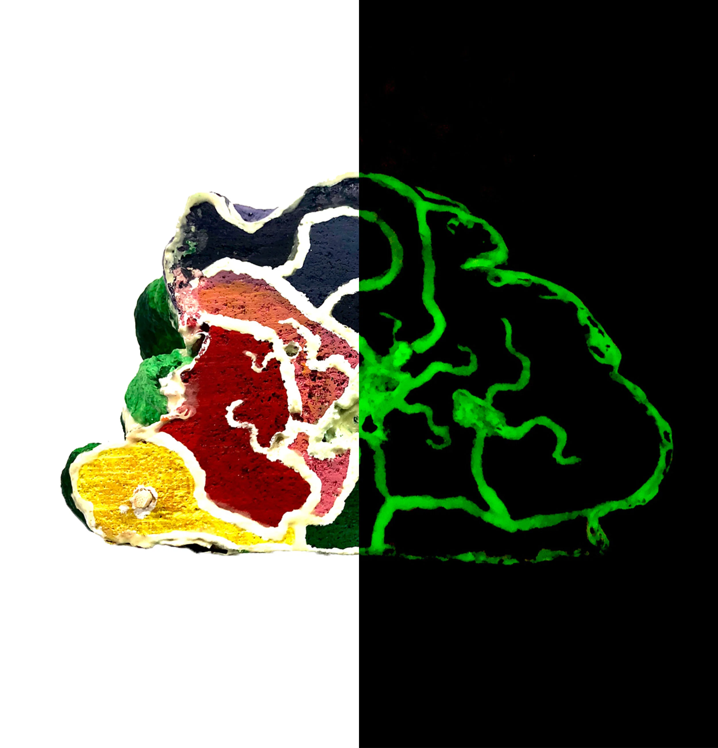 Brain Cancer Cross Section