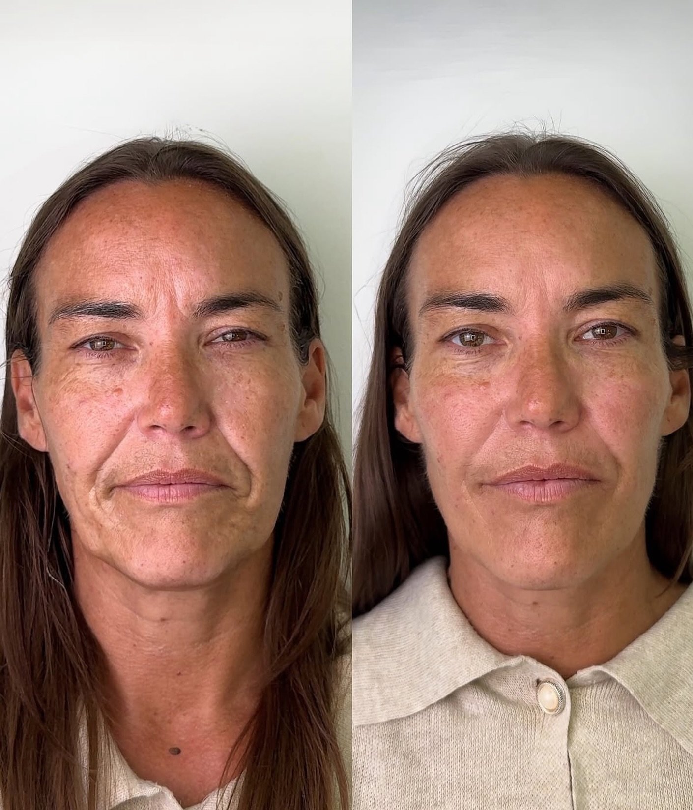 Bringing back one of our favourite results 🤍

Over time, the face naturally loses volume, which can leave lines looking deeper and features less defined.
With this treatment, we placed dermal filler carefully across multiple areas to restore that lo