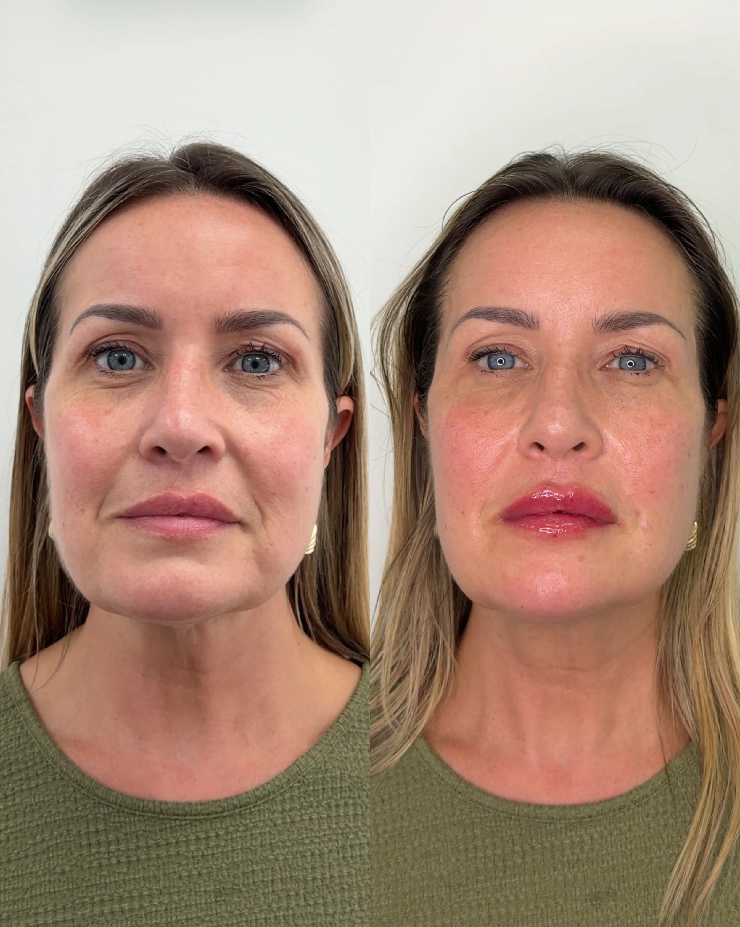 Have you noticed your cheeks aren&rsquo;t as full as they used to be? Or that lines are starting to form around your mouth?

That&rsquo;s volume loss, and it&rsquo;s one of the first signs of structural aging.

Cheek and lip filler, placed correctly,