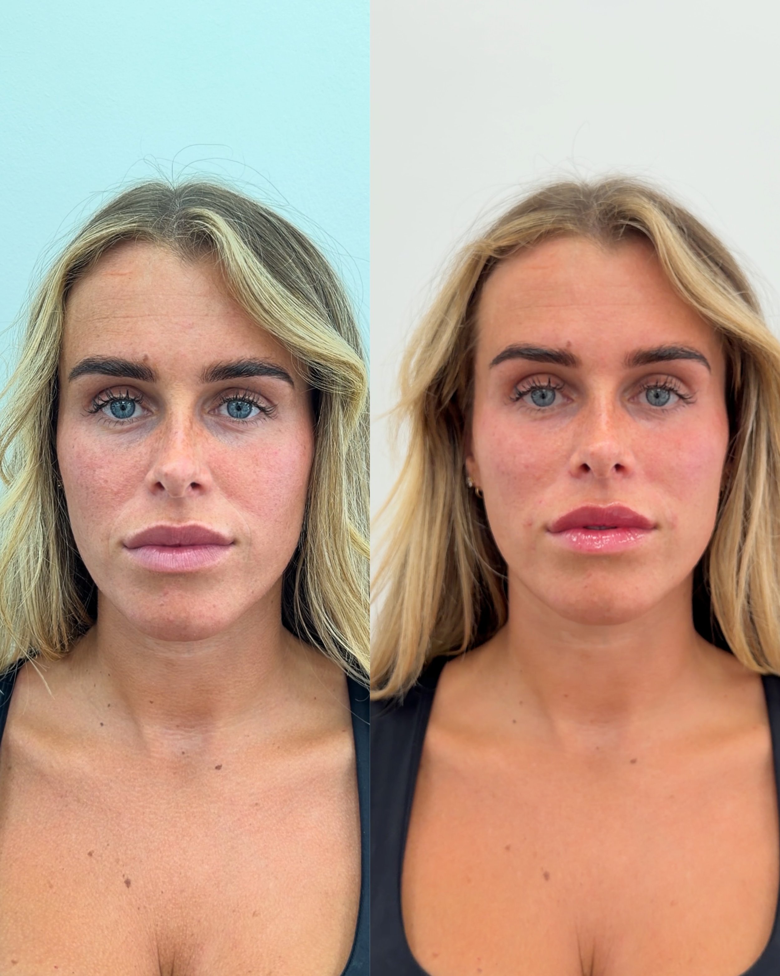 Tiny tweaks that make all the difference.

Filler placed strategically to restore volume and define shape.

DM me for a free consultation.