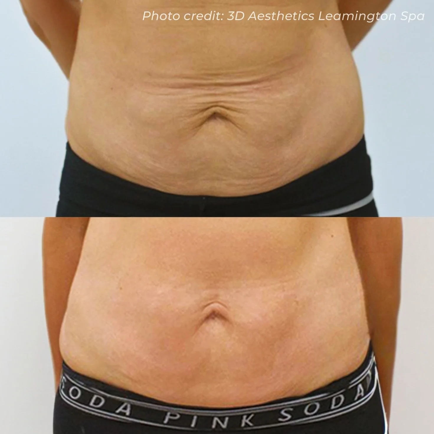 Loose skin on the stomach doesn&rsquo;t respond to cream. It doesn&rsquo;t respond to exercise either.

The skin has lost its structural integrity - the collagen and elastin underneath just aren&rsquo;t there anymore.

RF microneedling changes that. 