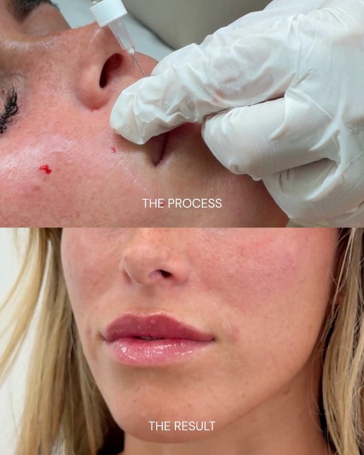 The process vs the result 💉

Book via the link in bio🤍