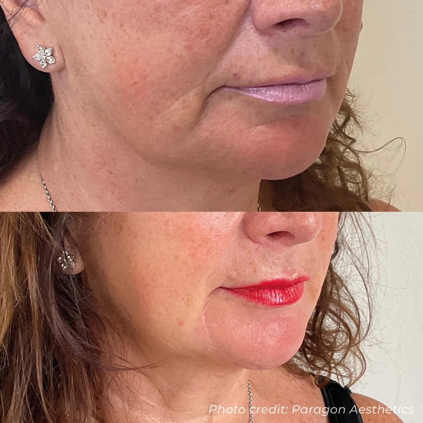 3D Dermaforce delivering real results 🤍

This client saw a significant improvement in the lines around the mouth, smoother, softer, and more refined with every session.

DM us or use the link in bio to book your consultation.

(not my photo)