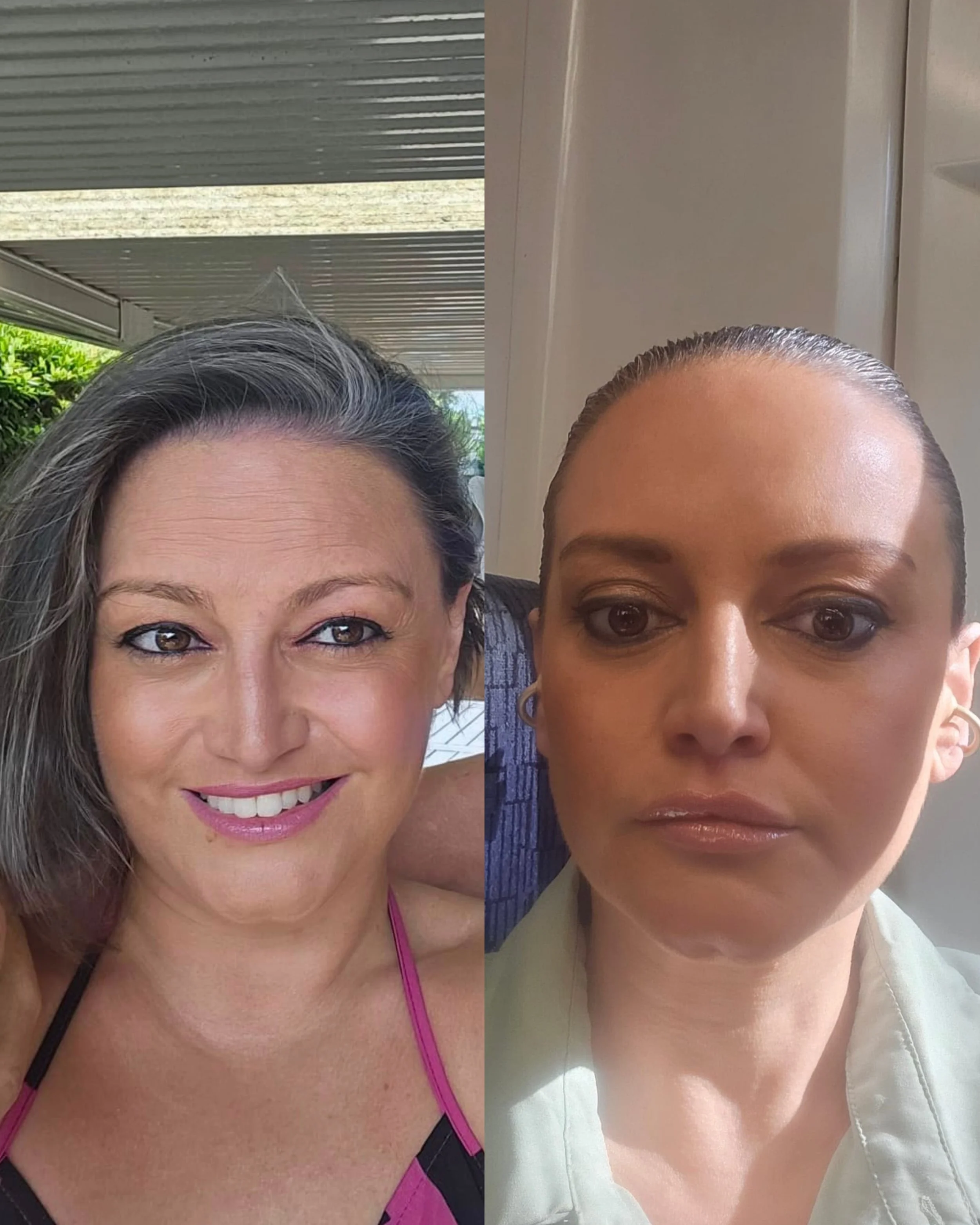 This is why consistency is key 🤍

Full face Botox, lip filler, and a tailored skincare routine, and honestly, we&rsquo;re so proud of these results.

You can see such a huge reduction in static lines, her skin quality looks incredible, and those lip