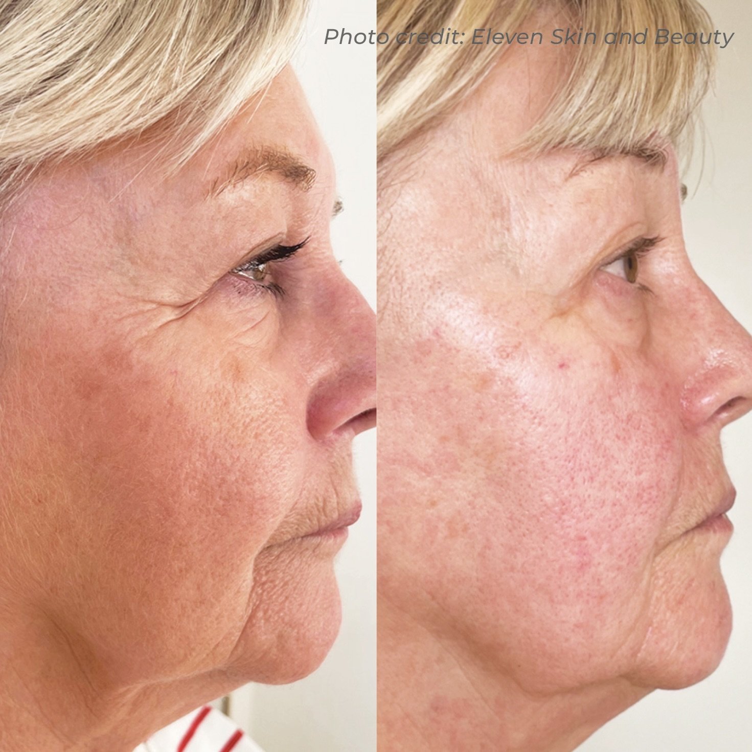 This client&rsquo;s 3D DermaForce treatment shows exactly why it&rsquo;s one of our most requested procedures. Visible improvement in jowl definition, smoother skin quality, and softened crow&rsquo;s feet, all without surgery or downtime.

DM or use 
