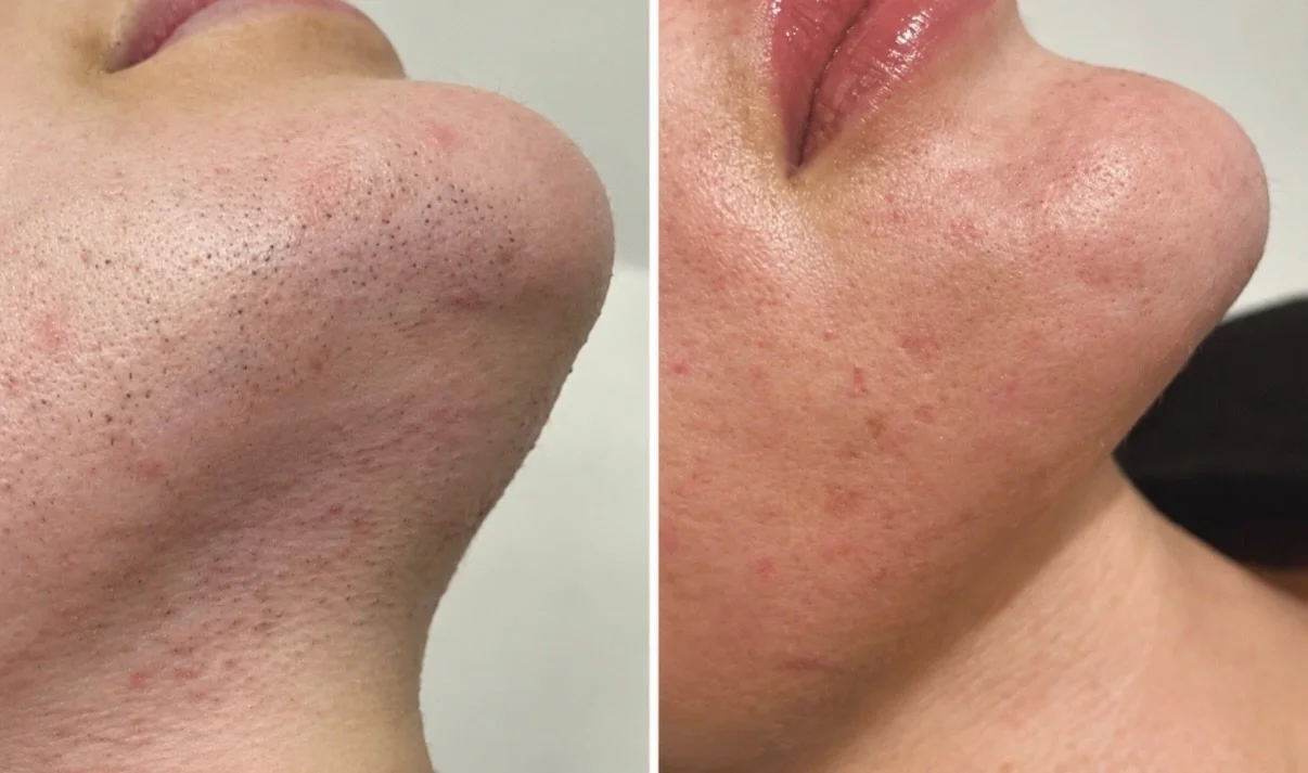 Facial laser hair removal can be a game changer, especially if you&rsquo;re dealing with excess growth from PCOS or just naturally have more hair than you&rsquo;d like on your face.

We use it to massively reduce (and in a lot of cases, get rid of) t
