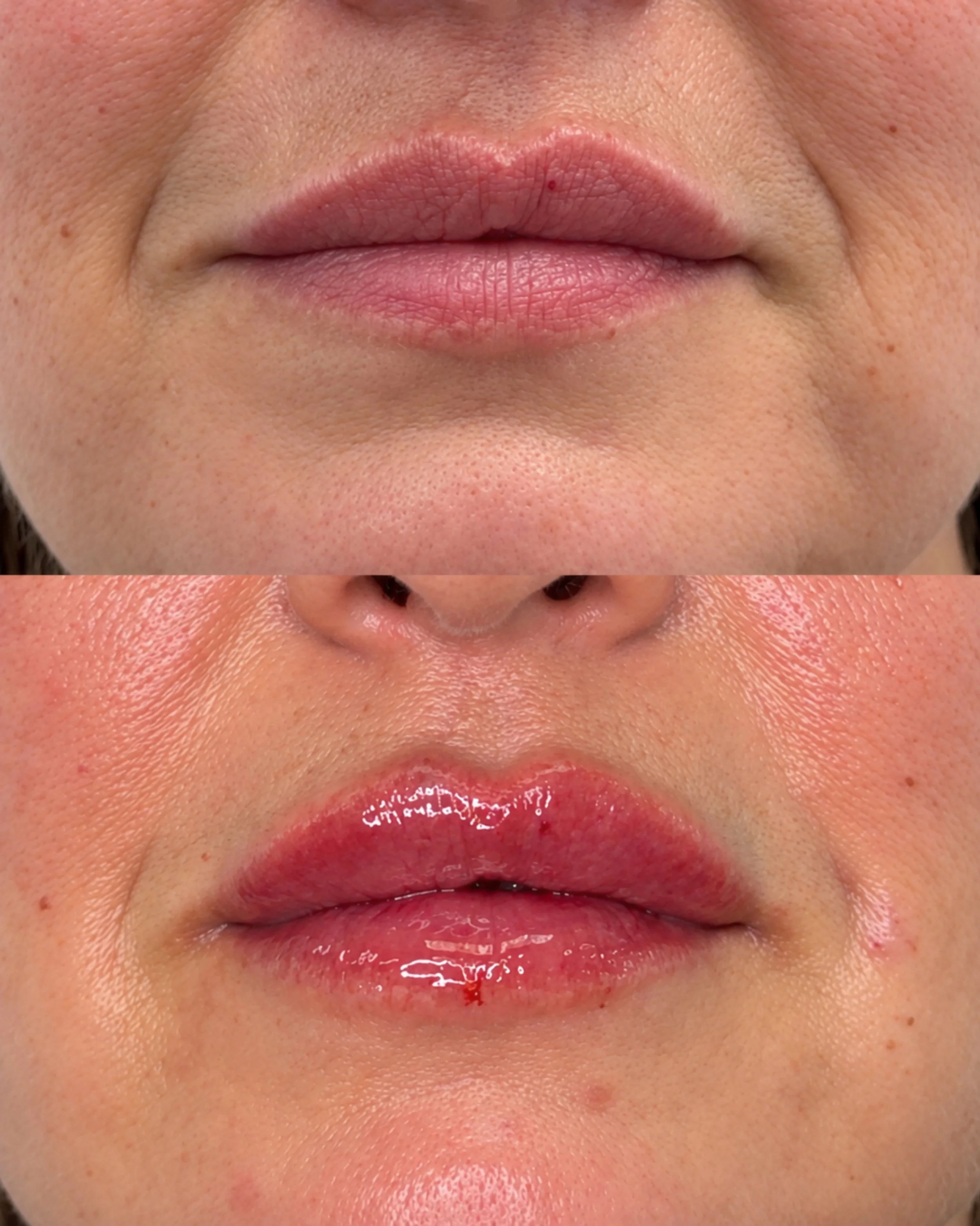Lip filler doesn&rsquo;t always have to mean bigger lips.

Sometimes it&rsquo;s simply about correcting a little asymmetry, adding definition and creating a more balanced shape.

Book via the link in our bio🤍