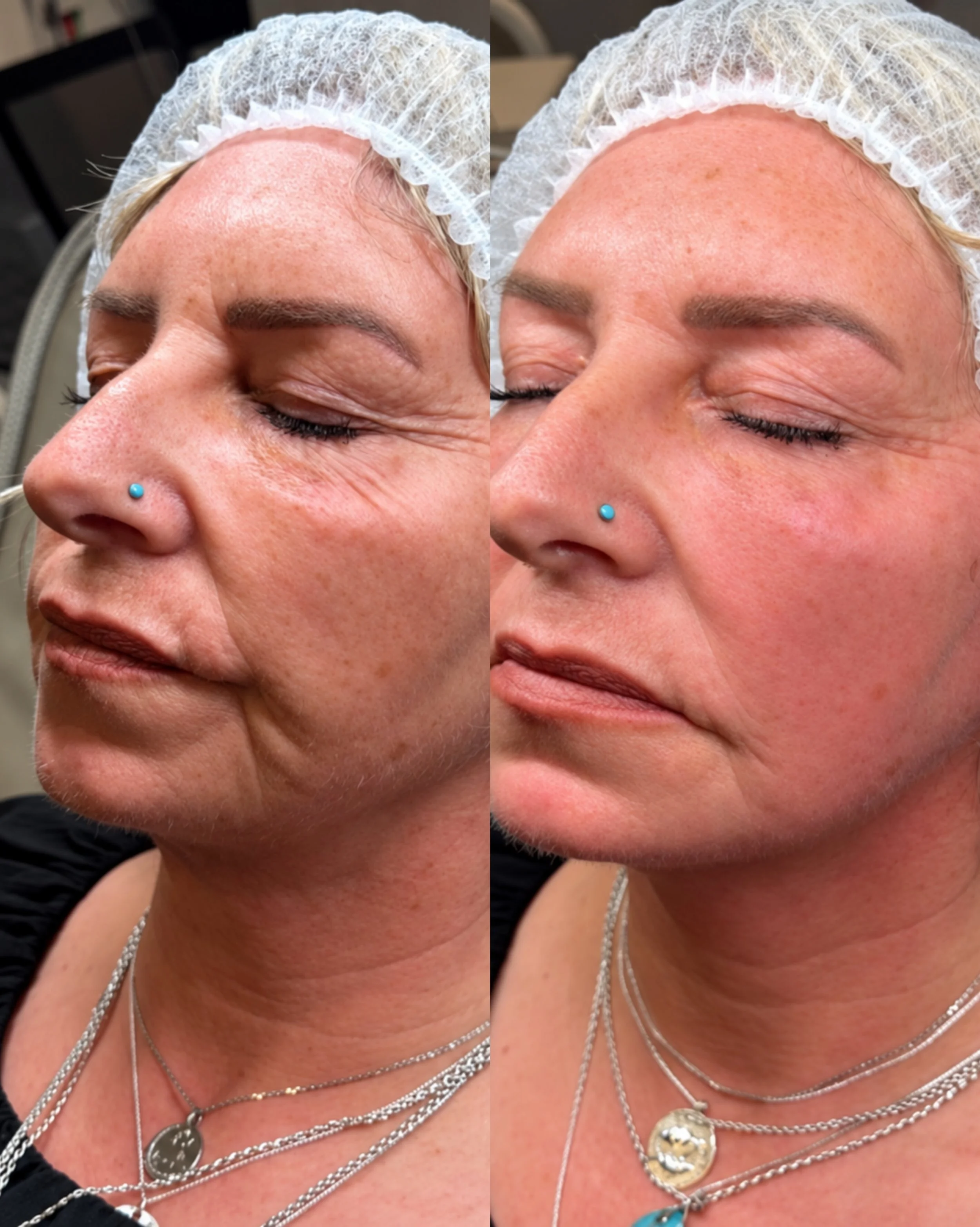 A more defined jawline, reduced jowls and a firmer, tighter-looking lower face.

These are the kind of results we love to see from Endopulse!

By working beneath the skin, Endopulse targets small pockets of stubborn fat while stimulating collagen pro