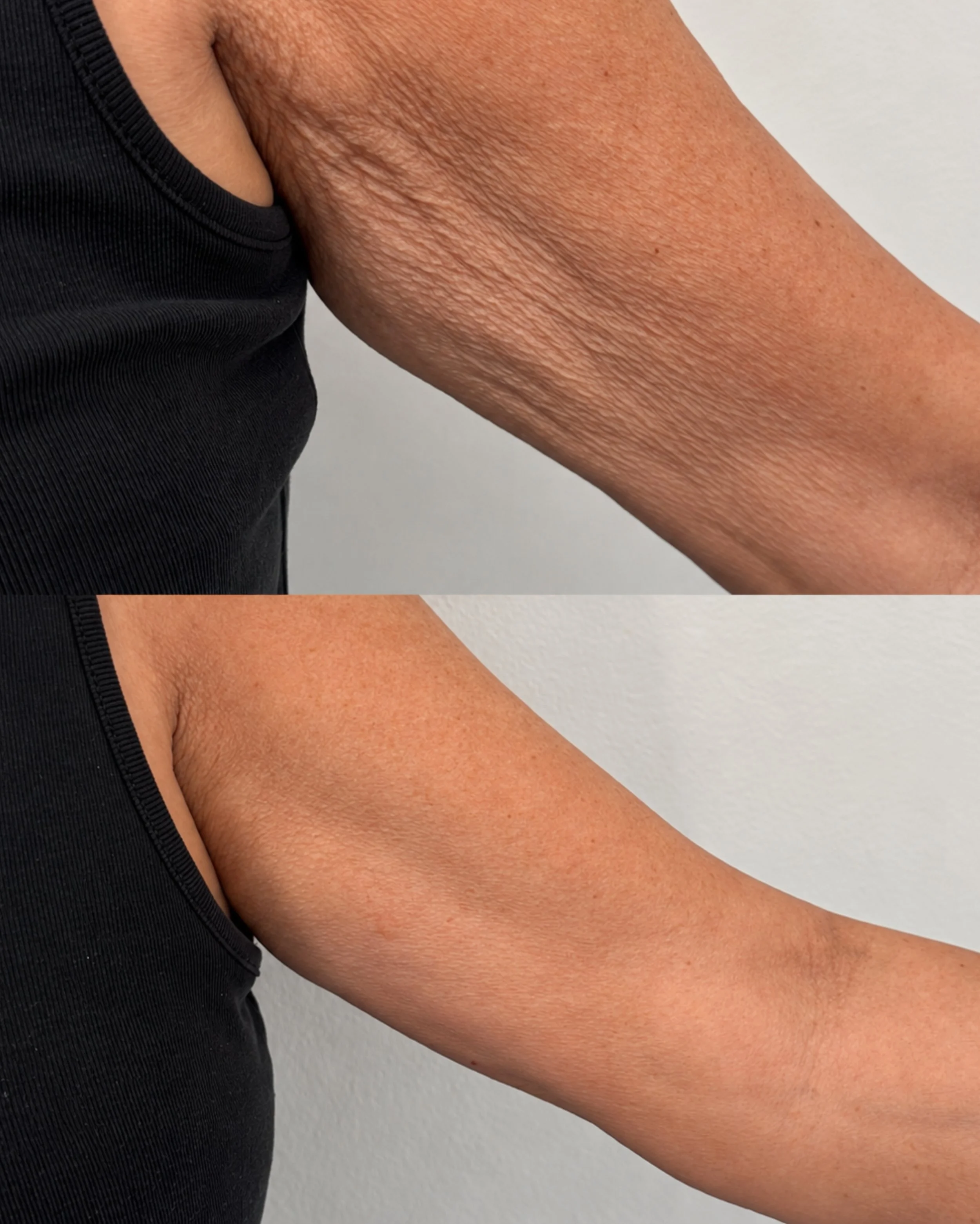 Endopulse isn&rsquo;t just for the face!

Look at the difference in skin laxity on the upper arms.

As we age, collagen production naturally slows down, which can leave the skin looking loose, crepey and less firm.

Endopulse works beneath the skin t