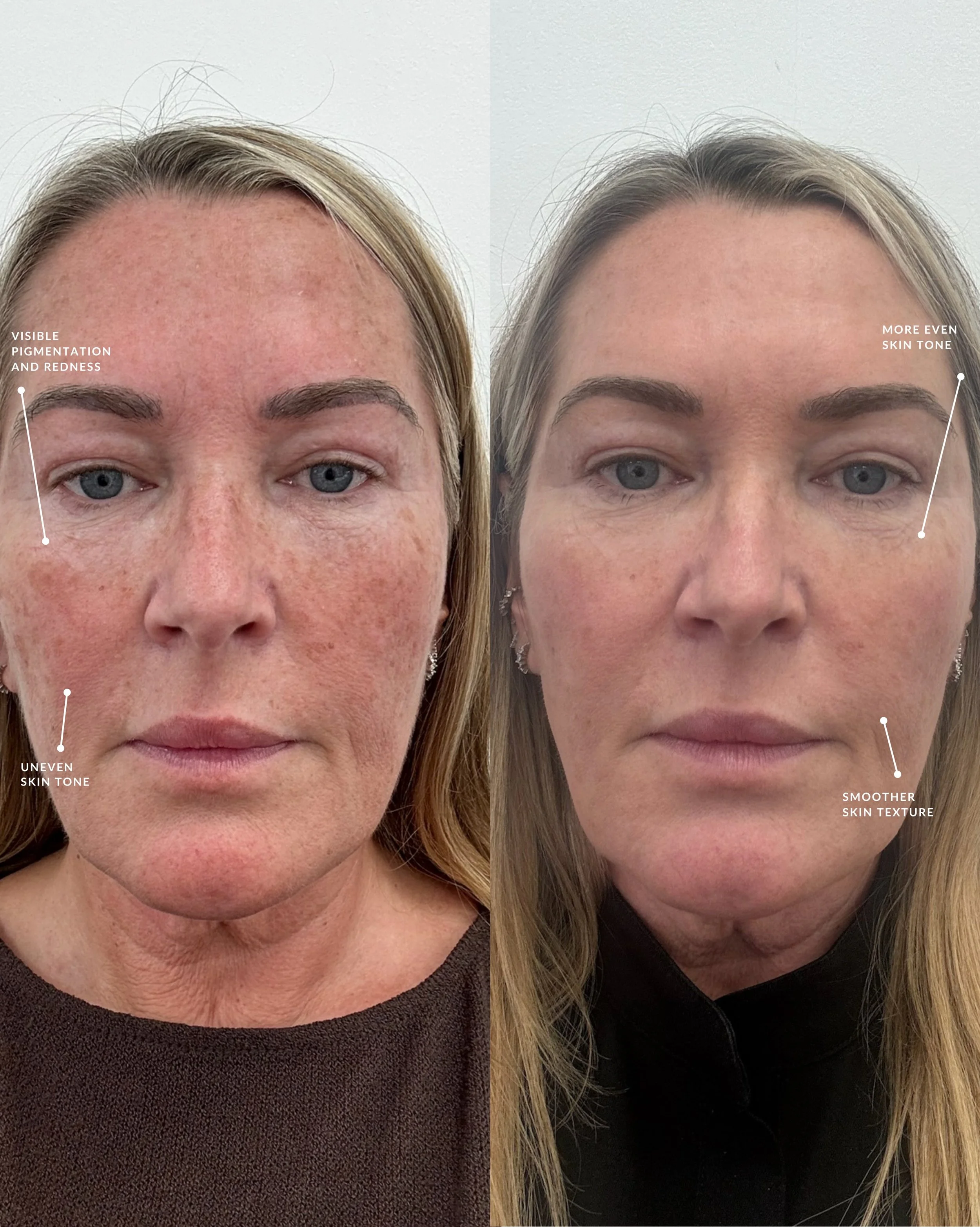 I wanted to show you just how amazing CO2 fractional laser can be, so I decided to have the treatment myself and document the entire process. And here are my results!

The biggest difference for me has been the reduction in pigmentation, but I&rsquo;