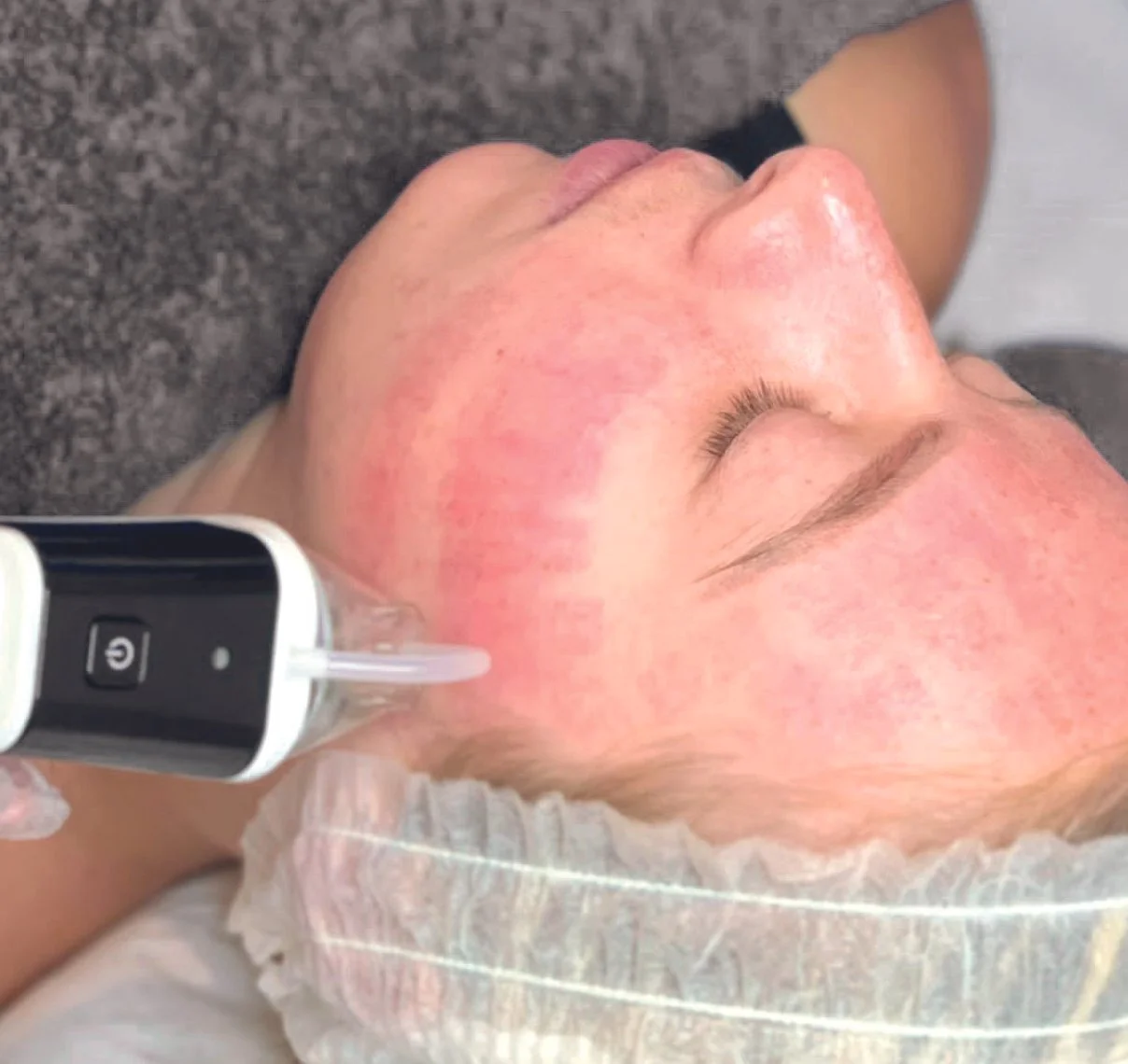 3D Dermaforce Treatments Rejuvenate with Alanna — Rejuvenate