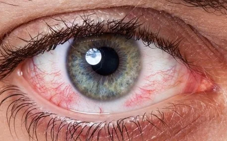 why-does-smoking-cannabis-give-you-red-eyes-and-ho.png