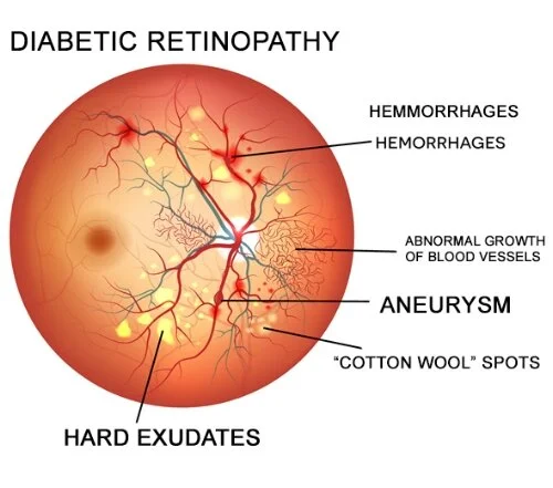 November is Diabetes Awareness Month 