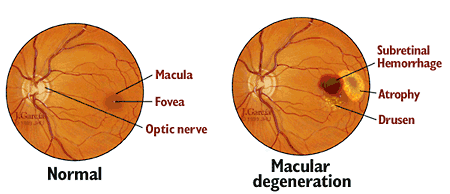 10 Things You Should Know About Age Related Macular Degeneration (AMD)
