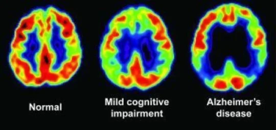pet scan.jpg