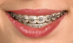 Self Ligating Braces