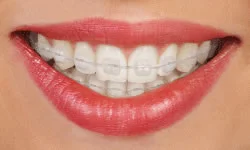 Ceramic Braces