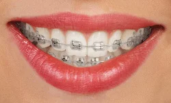 Traditional Metal Braces