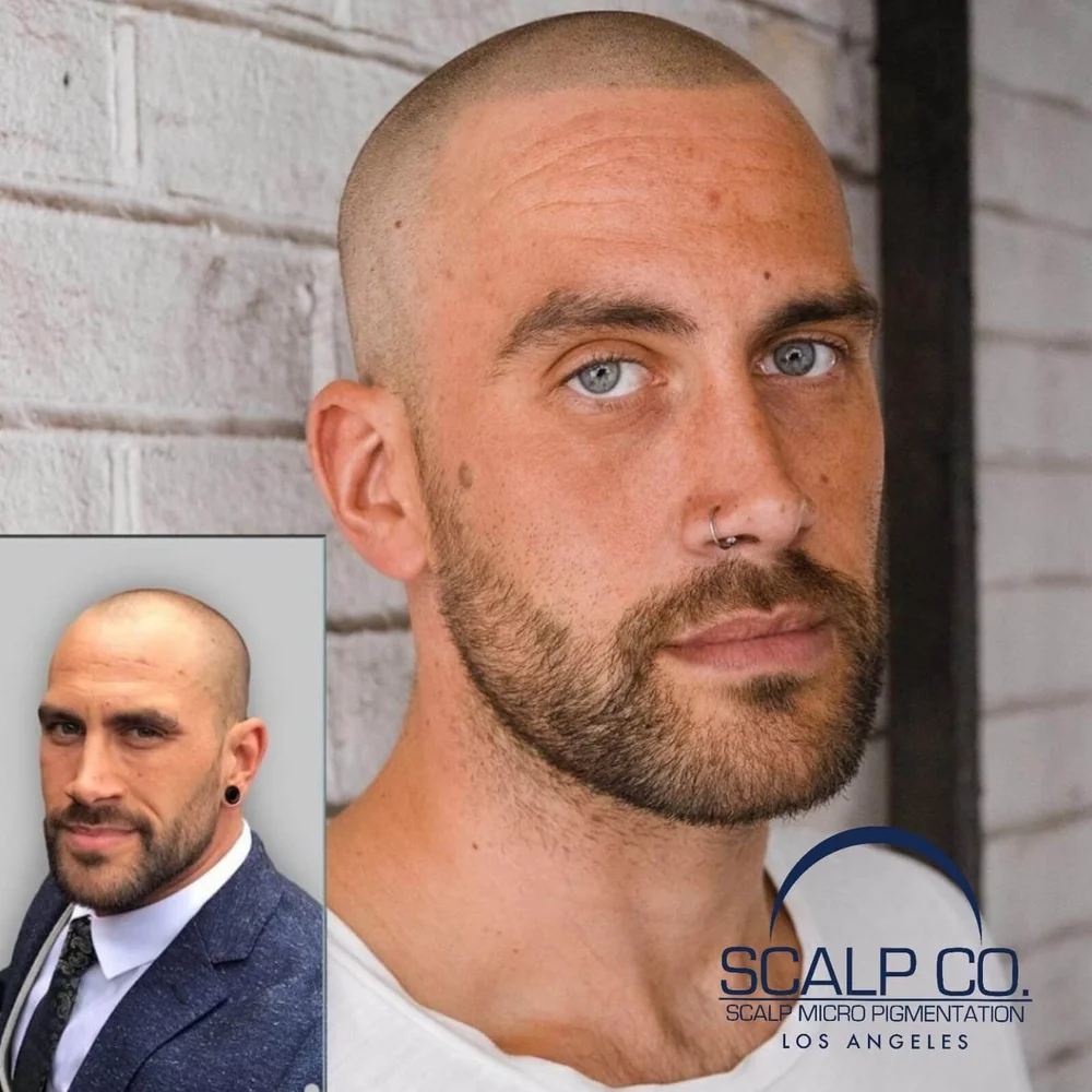 Scalp Co. hairline restoration before-and-after composite
