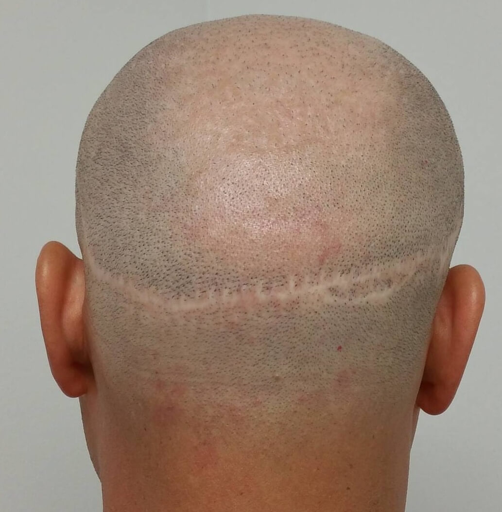 Hair-transplant-Scar-Fix.JPG