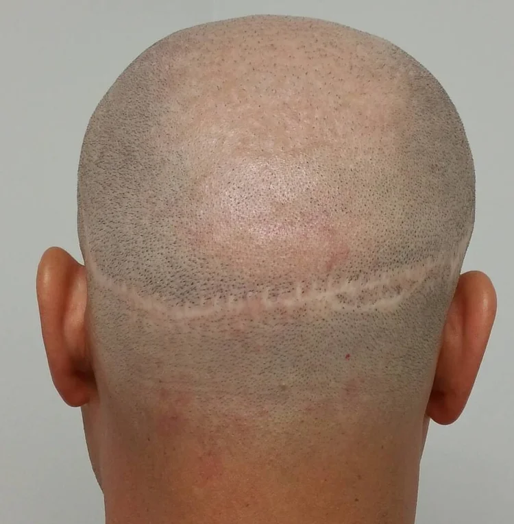 Before scar camouflage treatment