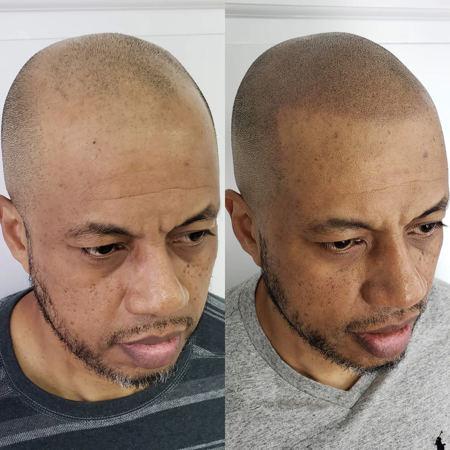 Who Is A Candidate For Micropigmentation Got Scalp