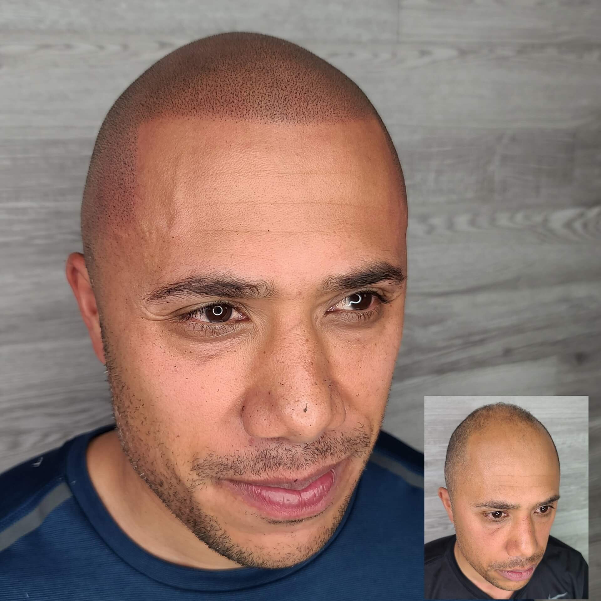 Scalp Micropigmentation SMP Semantics Terminology and Standards  ISHRS