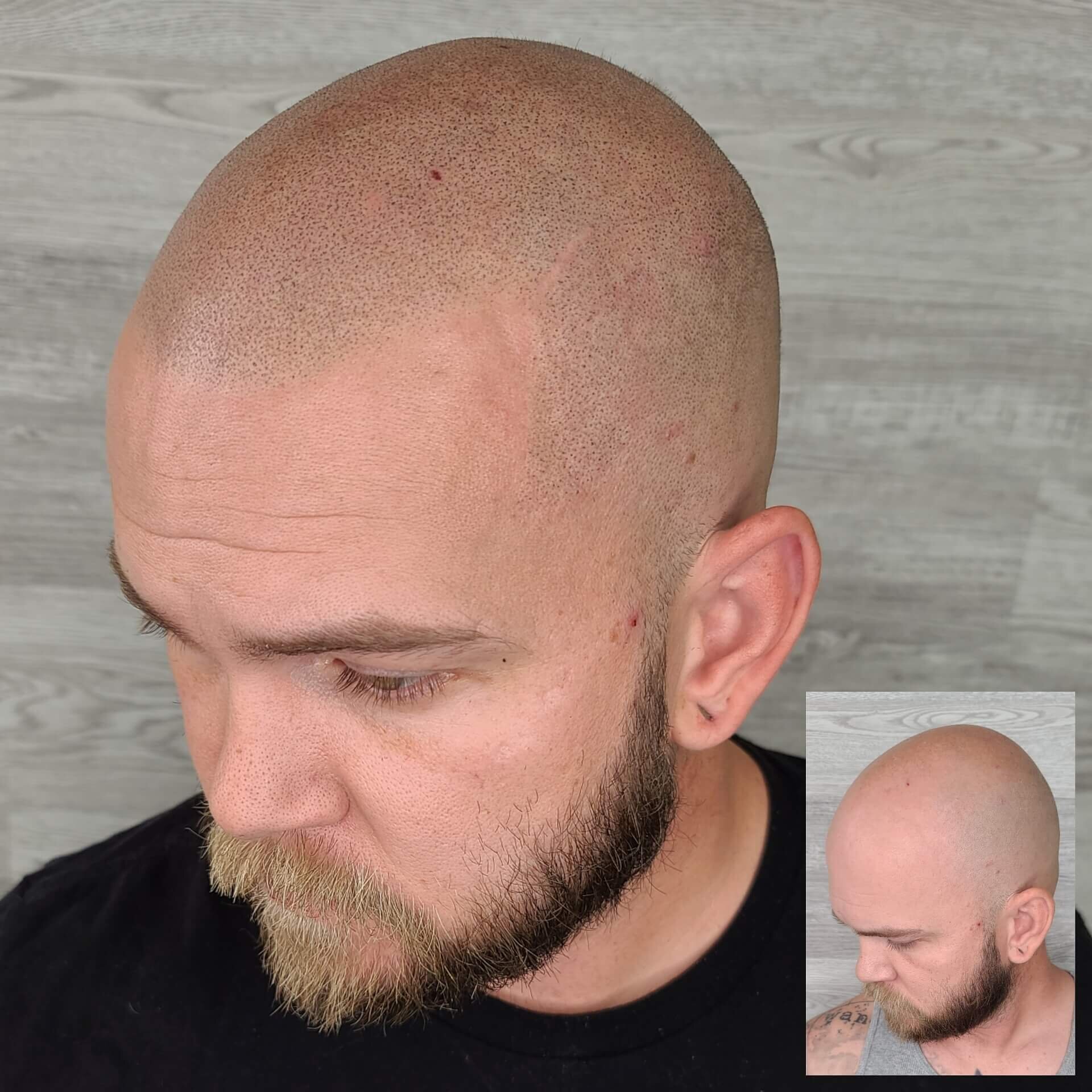 Balding leads to a permanent bad-hair day — Got Scalp