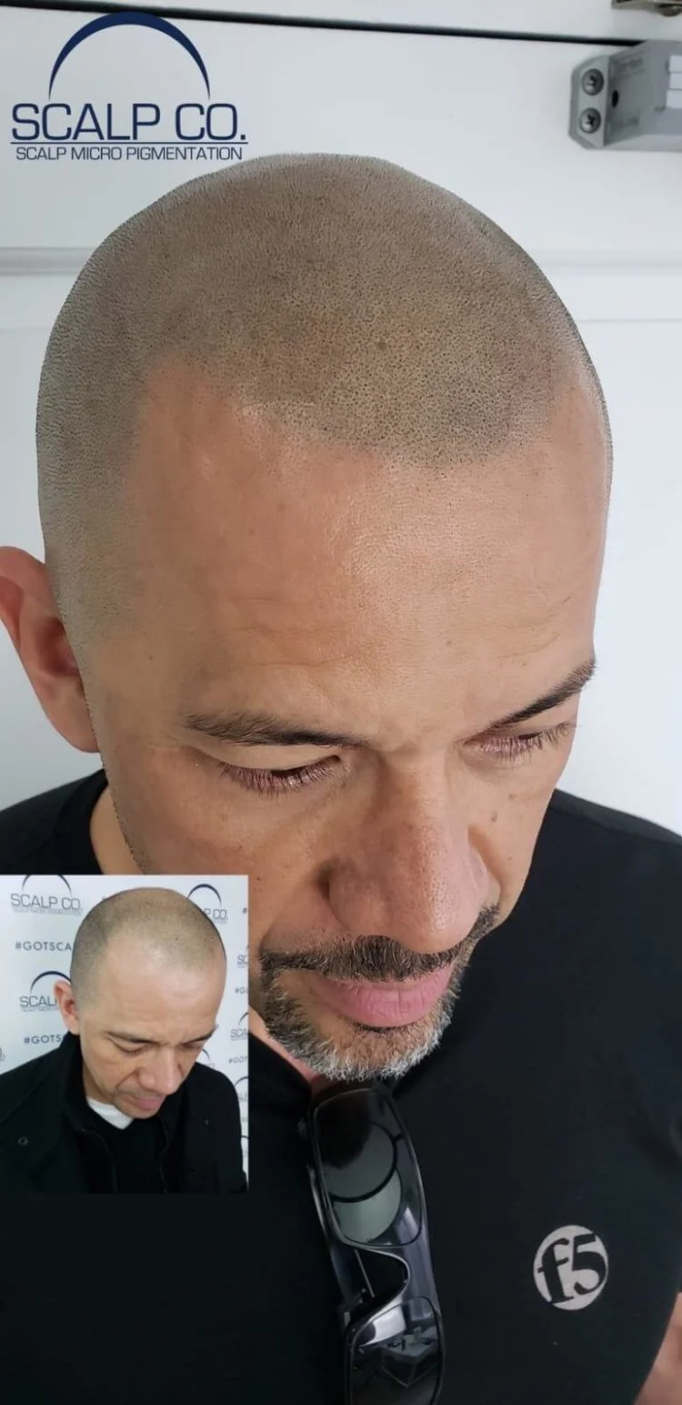 The Permanent Bad-Hair Day: How Balding Affects Your Life and Confidence