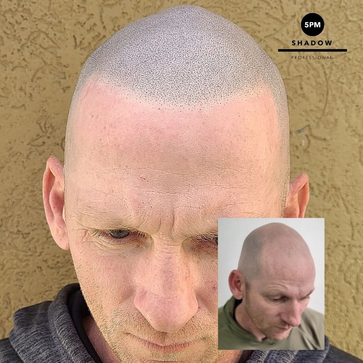 Scalp Culture - ⚡️⚡️HAIR TATTOO RESULTS - SCALP MICROPIGMENTATION  @scalpculture Always natural results for our clients🚀 ⠀ SMP IS A COSMETIC HAIR  TATTOO - For all types of hair loss ✓ 📍We