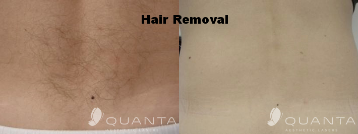 Copy of Copy-of-Hair-Removal-Back-IPL_Before_After.png