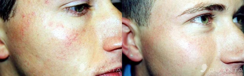 Copy of Vascular-Face-1064_Before_After.png