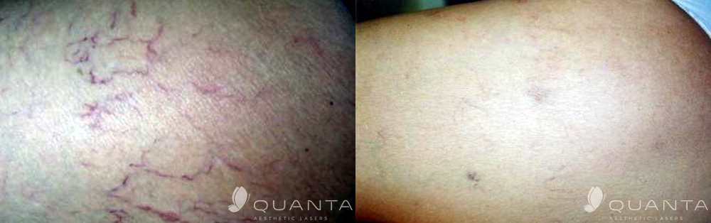 Copy of Vascular-Leg-Veins-1064_Before_After.png