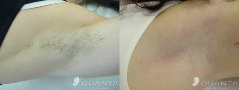 Copy of Hair-Removal-Armpit-755-Before_After.png