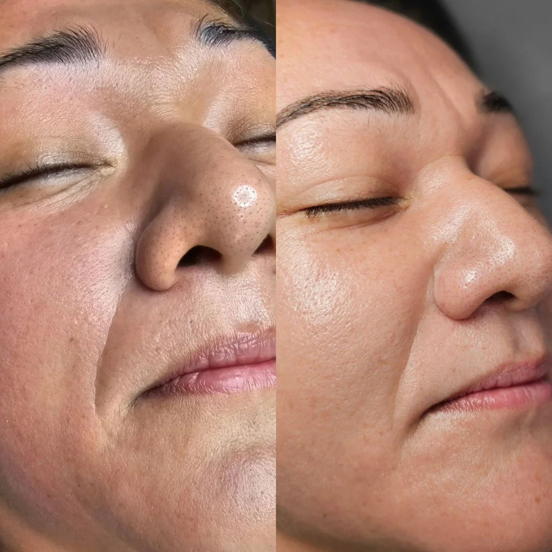 ProCell Microchanneling in NYC | Skin Rejuvenation Experts | New York ...