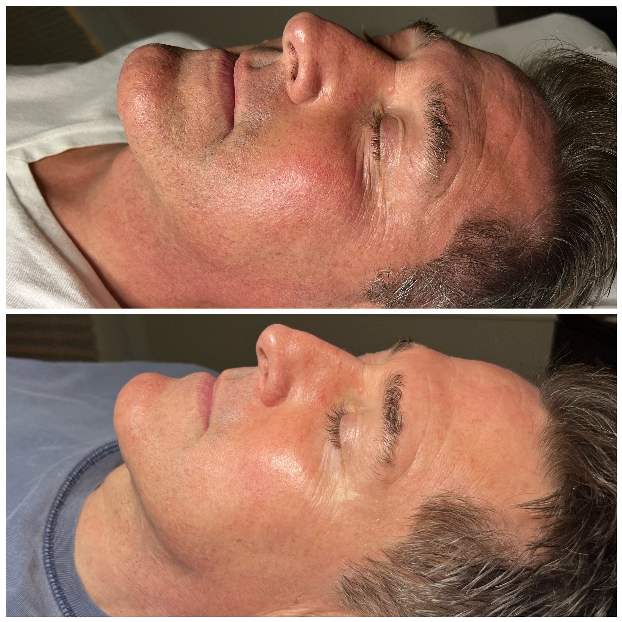 procell microchanneling before and after.JPEG