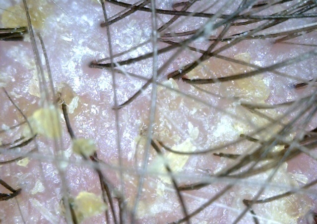 Oily, congested scalp