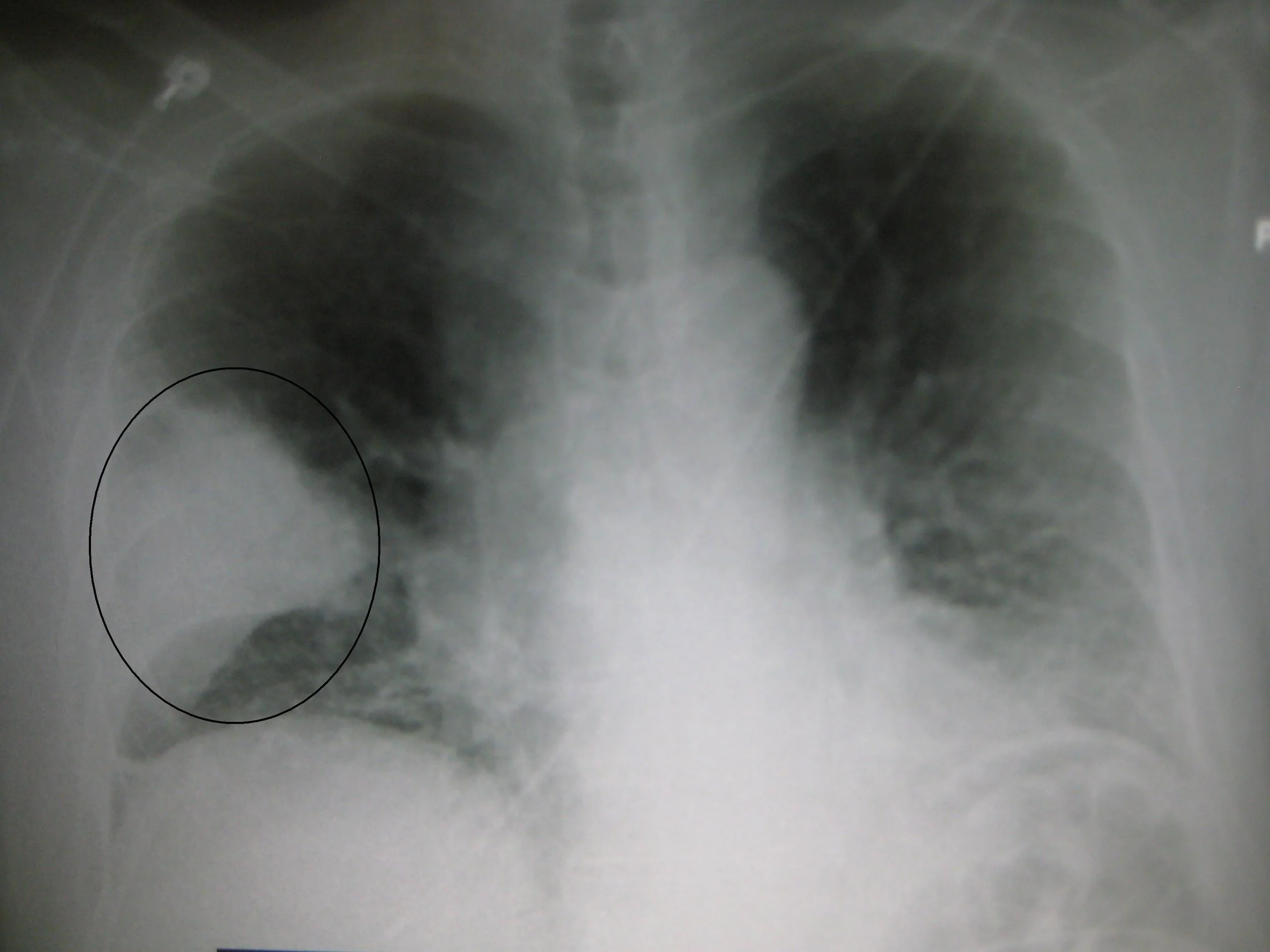 A similar CXR to the one taken in our patient. The white area indicates presence of fluid.