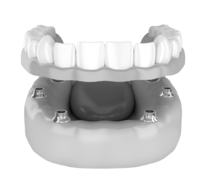 dentures-north-palm-beach.png